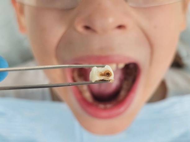 Best Broken or Chipped Tooth Repair in Blaine, MN